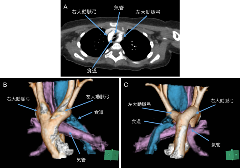 Pediatric Cardiology and Cardiac Surgery 40(2): 132-137 (2024)