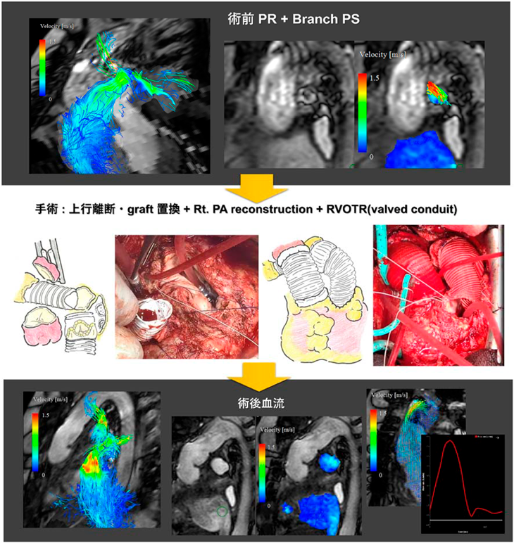Pediatric Cardiology and Cardiac Surgery 40(3): 186-192 (2024)