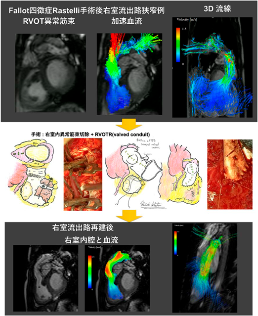 Pediatric Cardiology and Cardiac Surgery 40(3): 186-192 (2024)