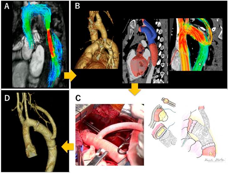 Pediatric Cardiology and Cardiac Surgery 40(3): 186-192 (2024)