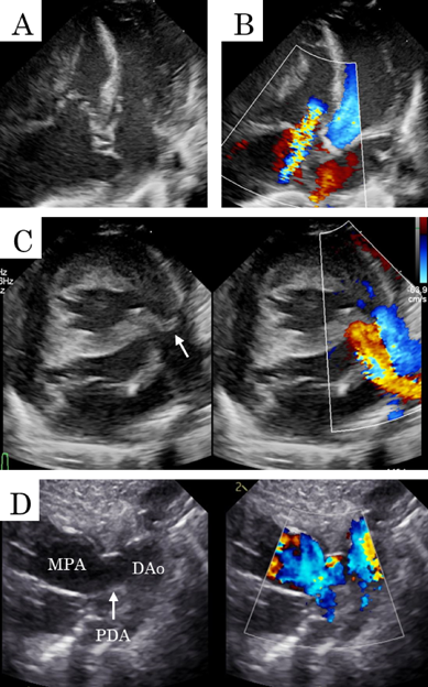 Pediatric Cardiology and Cardiac Surgery 41(2): 102-107 (2025)