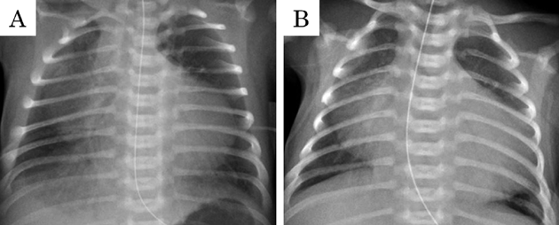 Pediatric Cardiology and Cardiac Surgery 41(2): 102-107 (2025)