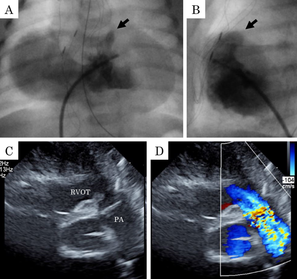 Pediatric Cardiology and Cardiac Surgery 41(2): 102-107 (2025)