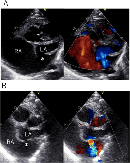 Pediatric Cardiology and Cardiac Surgery 41(3): 133-137 (2025)