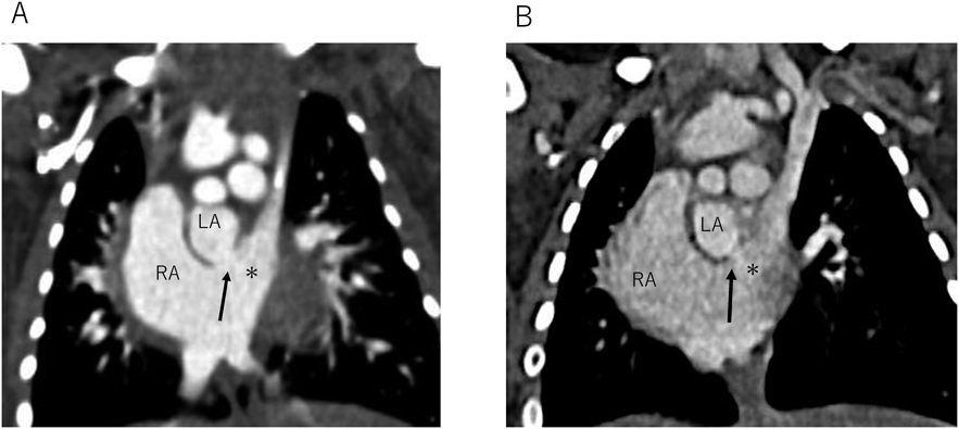 Pediatric Cardiology and Cardiac Surgery 41(3): 133-137 (2025)