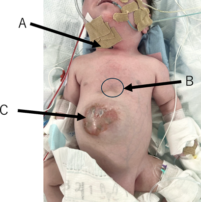 Pediatric Cardiology and Cardiac Surgery 41(1): 51-57 (2025)