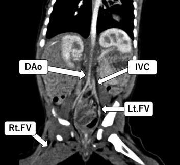 Pediatric Cardiology and Cardiac Surgery 41(1): 51-57 (2025)