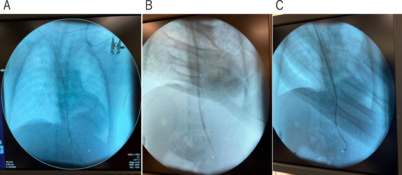 Pediatric Cardiology and Cardiac Surgery 41(1): 51-57 (2025)
