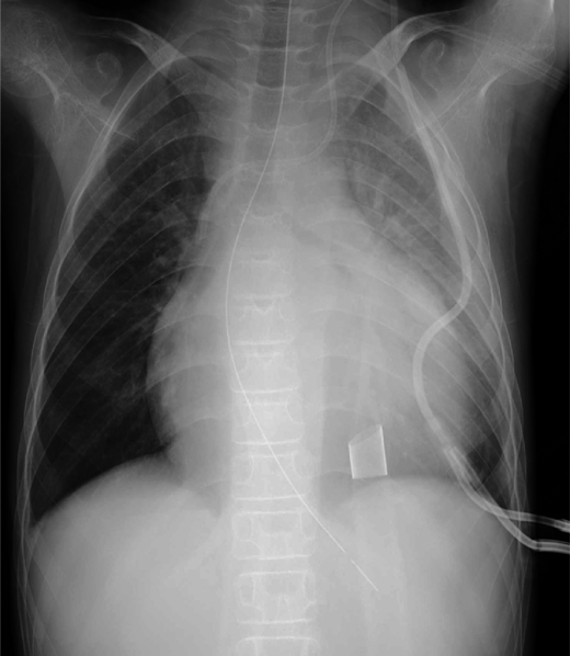 Pediatric Cardiology and Cardiac Surgery 41(1): 58-62 (2025)