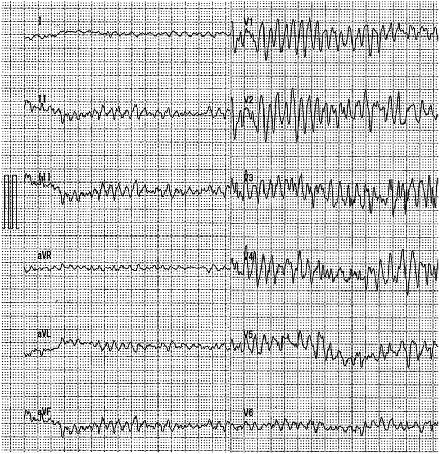 Pediatric Cardiology and Cardiac Surgery 41(1): 58-62 (2025)