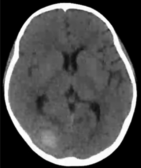 Pediatric Cardiology and Cardiac Surgery 41(1): 58-62 (2025)